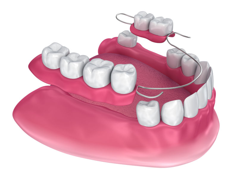 Removable Dentures, Partials, Types of Dentures and Cost in Sparta, NC